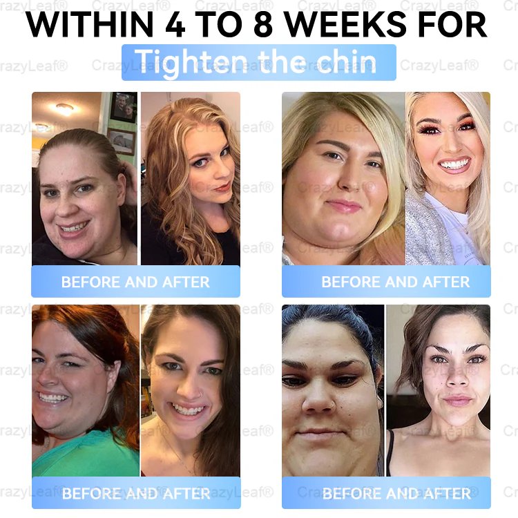 "Last 30 Minutes: Buy One, Get One Free!" Buildleaf® Tirzepatide Nano Microneedle Patch with Collagen & Matrixyl 3000 丨Targets Obesity, Loose Skin, High Blood Pressure, Diabetes, Fatty Liver, Joint Pain, Brain Fog, Low Energy, Body Aches, and More 03