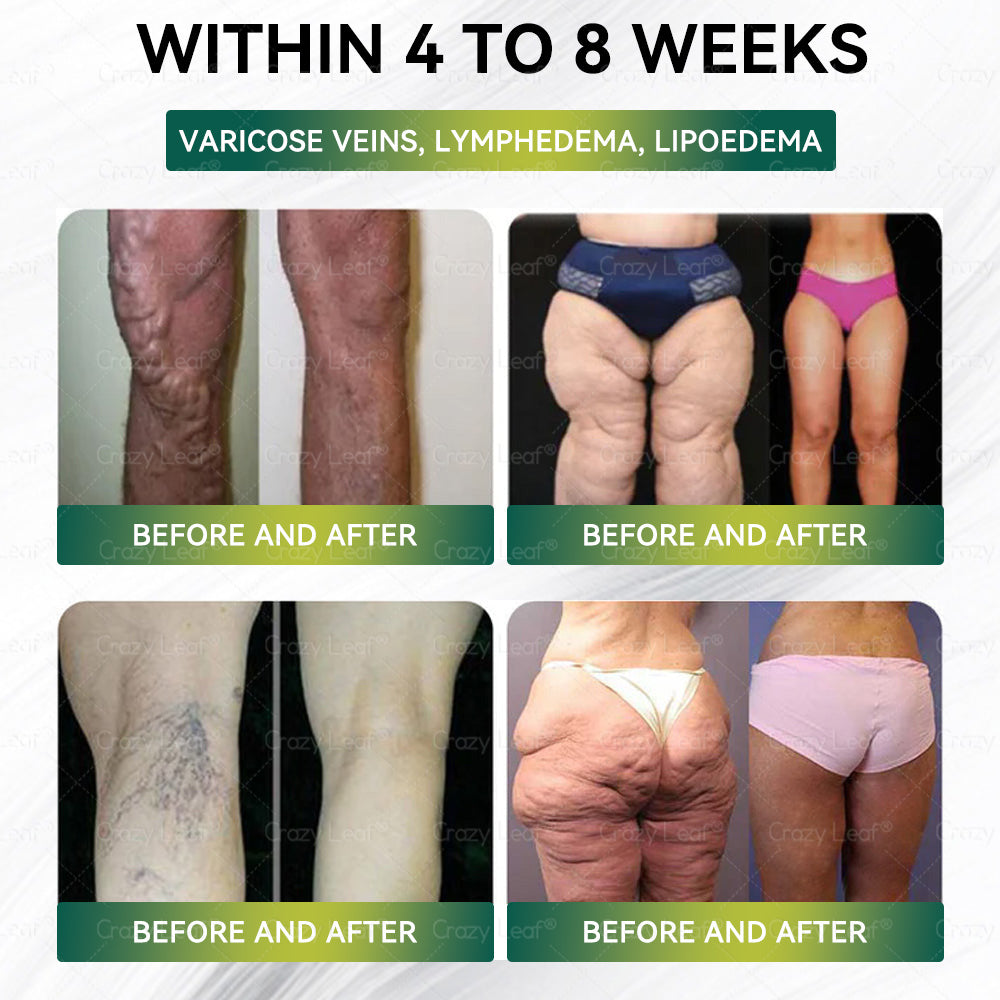 When used together with CrazyLeaf® Oral Solution, the effect is boosted by up to 2 times! Purchase now and enjoy a limited-time 70% special discount, helping you achieve your weight loss and health goals faster!