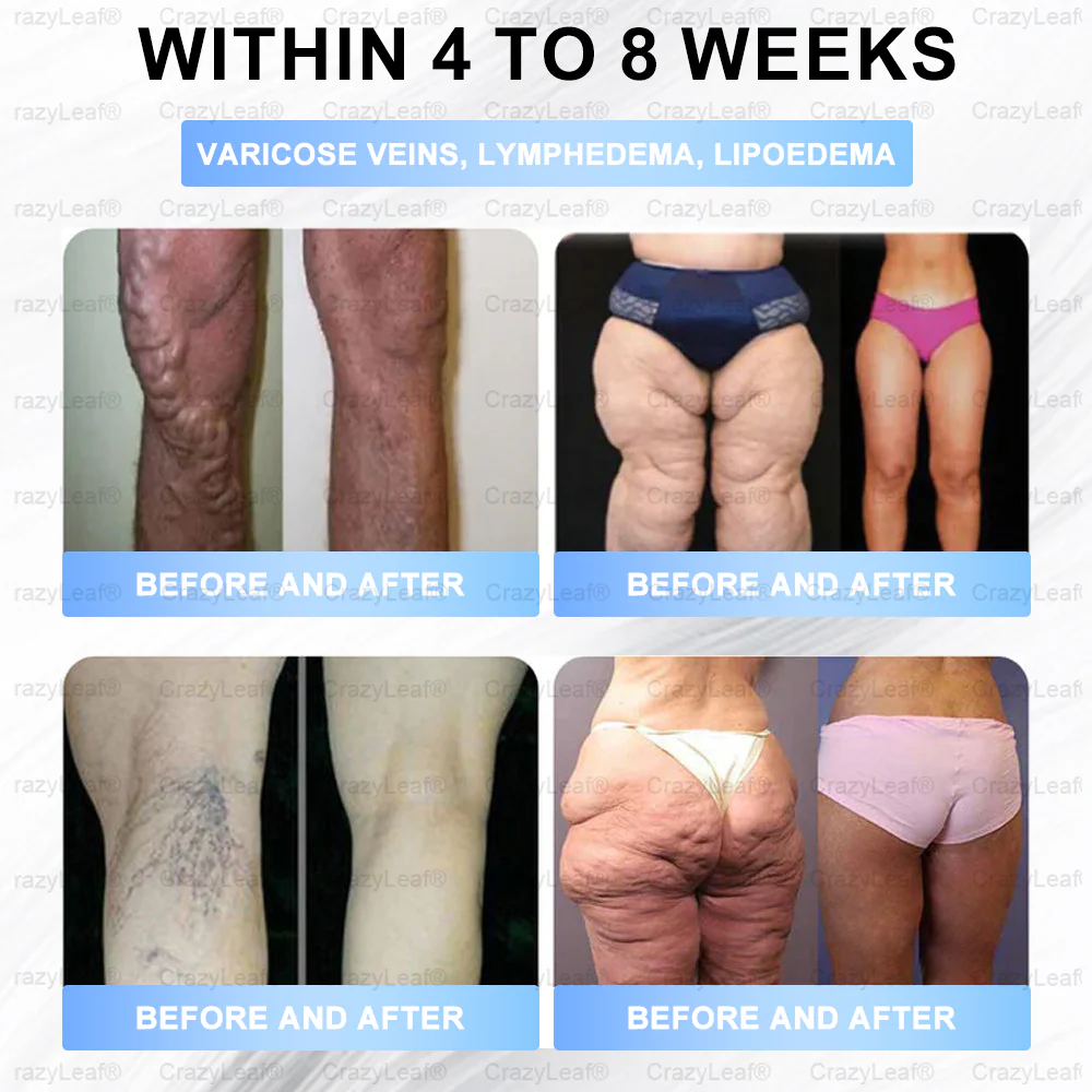 "Last 30 Minutes: Buy One, Get One Free!" 𝘽𝙪𝙞𝙡𝙙𝙡𝙚𝙖𝙛® 𝙏𝙞𝙧𝙯𝙚𝙥𝙖𝙩𝙞𝙙𝙚 𝙉𝙖𝙣𝙤 𝙈𝙞𝙘𝙧𝙤𝙣𝙚𝙚𝙙𝙡𝙚 𝙋𝙖𝙩𝙘𝙝 with Collagen & Matrixyl 3000 丨Targets Obesity, Loose Skin, High Blood Pressure, Diabetes, Fatty Liver, Joint Pain, Brain Fog, Low Energy, Body Aches, and More
