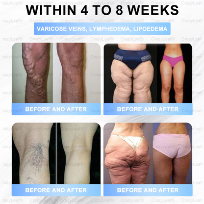 "Last 30 Minutes: Buy One, Get One Free!" 𝘽𝙪𝙞𝙡𝙙𝙡𝙚𝙖𝙛® 𝙏𝙞𝙧𝙯𝙚𝙥𝙖𝙩𝙞𝙙𝙚 𝙉𝙖𝙣𝙤 𝙈𝙞𝙘𝙧𝙤𝙣𝙚𝙚𝙙𝙡𝙚 𝙋𝙖𝙩𝙘𝙝 with Collagen & Matrixyl 3000 丨Targets Obesity, Loose Skin, High Blood Pressure, Diabetes, Fatty Liver, Joint Pain, Brain Fog, Low Energy, Body Aches, and More